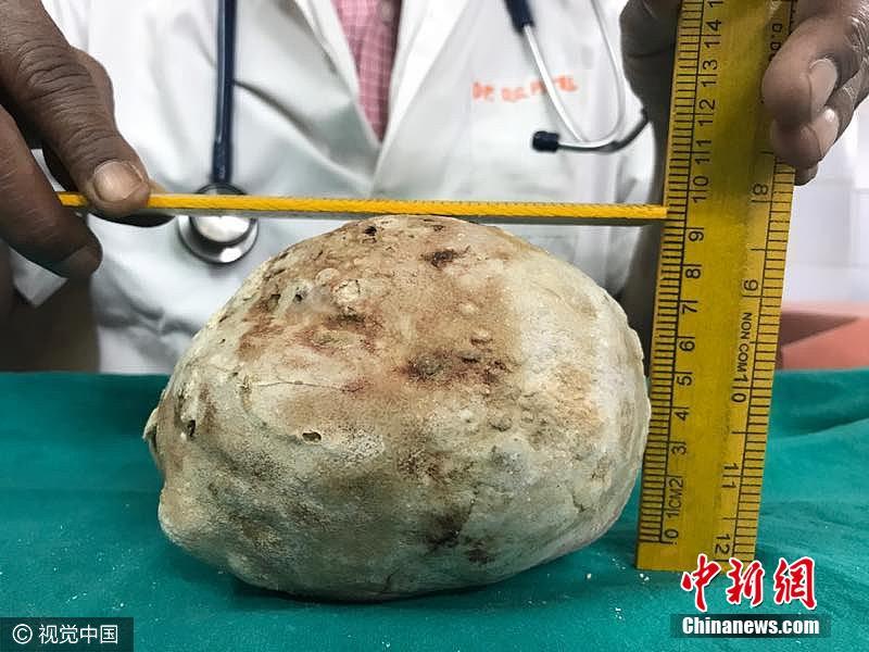 印度男子腹痛入院 膀胱取出1.5公斤巨型結石