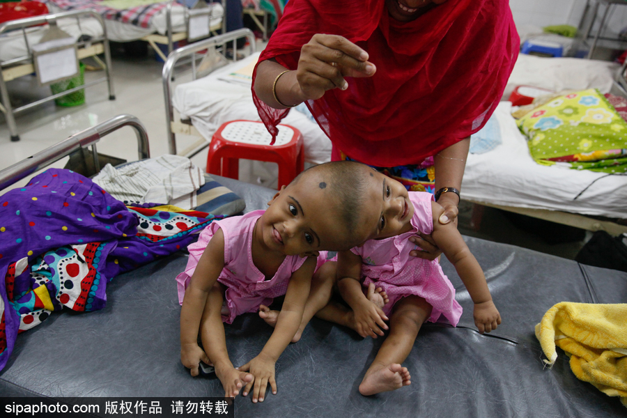 孟加拉國連頭嬰兒 至少到兩歲才能進行手術